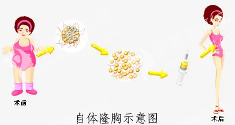 广东省人民医院美容整形外科脂肪隆胸