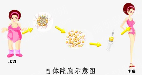 郑大五附院整形外科脂肪隆胸
