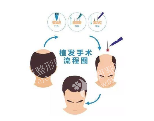 欧菲整形美容医院发际线植发