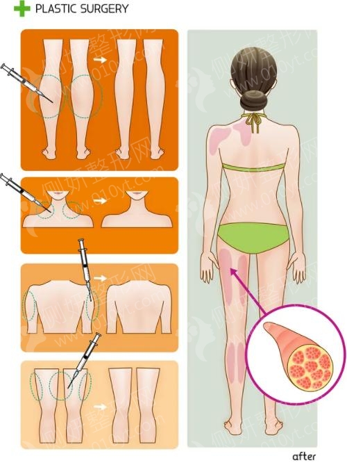 成都润美玉之光整形医院大腿吸脂