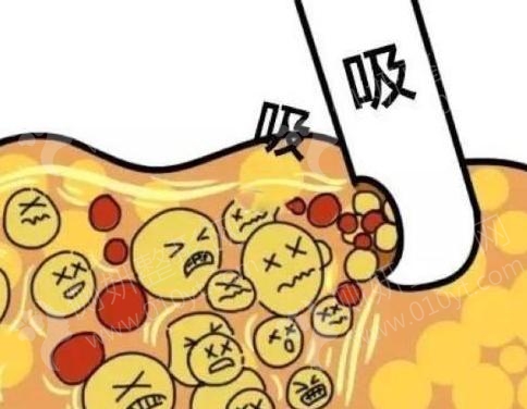 成都铜雀台整形美容医院吸脂手术