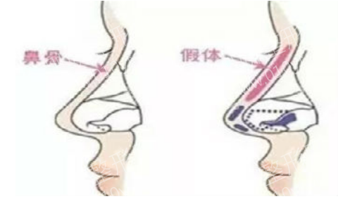 梧州市人民医院整形外科微晶瓷隆鼻