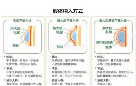 柳州市工人医院烧伤整形外科玻尿酸隆胸
