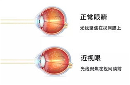 济南眼科近视手术医院排名