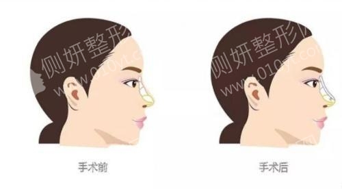 南宁市第一人民医院整形美容外科硅胶隆鼻