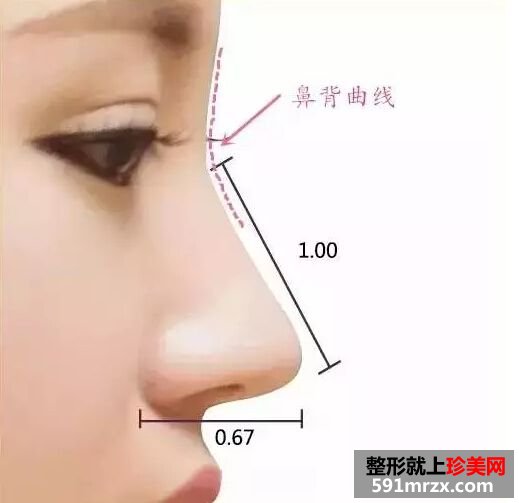 成美做假体隆鼻手术多少钱