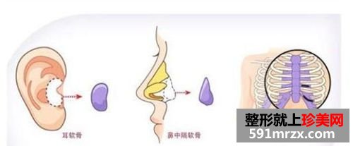 自体软骨隆鼻的优点有哪些