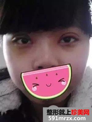 韩式芭比翘睫平行双眼皮前后对比效果图片和恢复过程