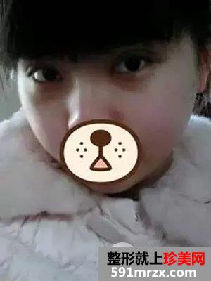韩式芭比翘睫平行双眼皮前后对比效果图片和恢复过程