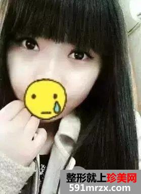 韩式芭比翘睫平行双眼皮前后对比效果图片和恢复过程