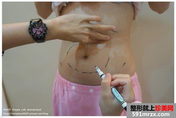 超音波溶脂术前过程