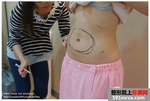 超音波溶脂术前测量