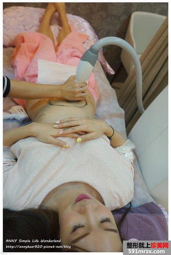 标靶震波溶脂过程