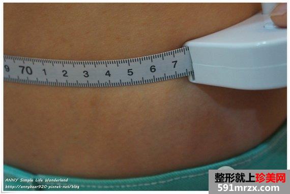 标靶震波溶脂术后腰围