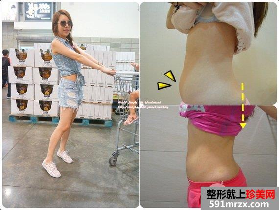 标靶震波溶脂效果
