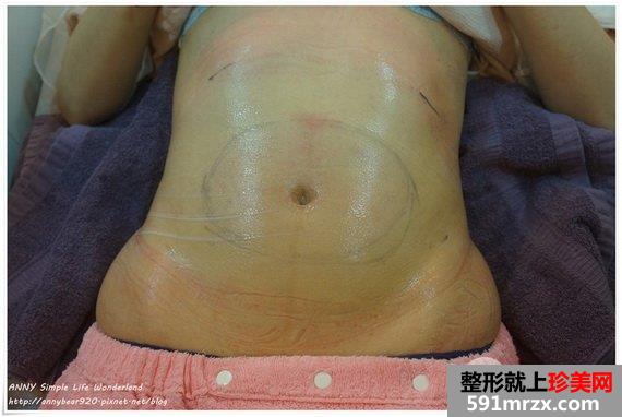 溶脂术后