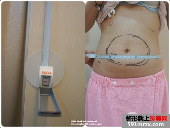 标靶震波溶脂术前测量