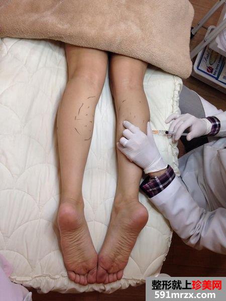 肉毒桿菌,瘦腿,萝蔔腿,美丽晶华