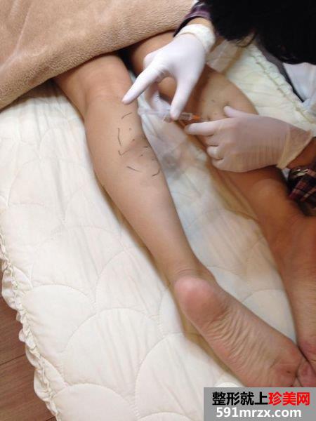 肉毒桿菌,瘦腿,萝蔔腿,美丽晶华