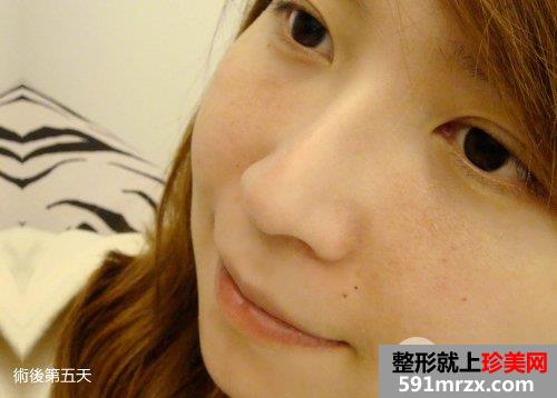 飞梭雷射,飞梭雷射后遗症,飞梭雷射失败,飞梭雷射术后保养,3d变频飞梭雷射,飞梭雷射费用,飞梭雷射价钱,毛孔粗大,缩小毛孔,毛孔粗大怎么办,痘疤凹洞,凹洞,痘疤,痘疤消除法,痘疤如何消除,除痘疤,去痘疤,消痘疤