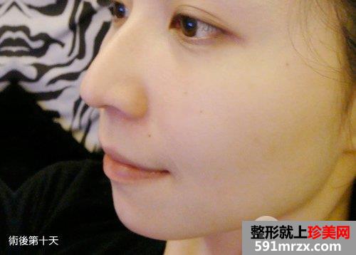 飞梭雷射,飞梭雷射后遗症,飞梭雷射失败,飞梭雷射术后保养,3d变频飞梭雷射,飞梭雷射费用,飞梭雷射价钱,毛孔粗大,缩小毛孔,毛孔粗大怎么办,痘疤凹洞,凹洞,痘疤,痘疤消除法,痘疤如何消除,除痘疤,去痘疤,消痘疤