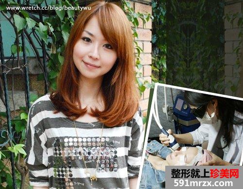 飞梭雷射,飞梭雷射后遗症,飞梭雷射失败,飞梭雷射术后保养,3d变频飞梭雷射,飞梭雷射费用,飞梭雷射价钱,毛孔粗大,缩小毛孔,毛孔粗大怎么办,痘疤凹洞,凹洞,痘疤,痘疤消除法,痘疤如何消除,除痘疤,去痘疤,消痘疤