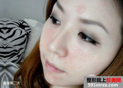 飞梭雷射,飞梭雷射后遗症,飞梭雷射失败,飞梭雷射术后保养,3d变频飞梭雷射,飞梭雷射费用,飞梭雷射价钱,毛孔粗大,缩小毛孔,毛孔粗大怎么办,痘疤凹洞,凹洞,痘疤,痘疤消除法,痘疤如何消除,除痘疤,去痘疤,消痘疤