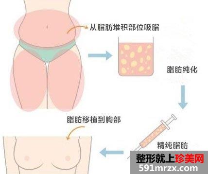 自体脂肪丰胸