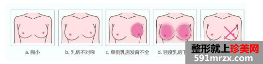 自体脂肪丰胸适宜人群