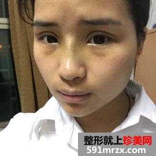 全切双眼皮+假体隆鼻+垫鼻尖最终效果图分享