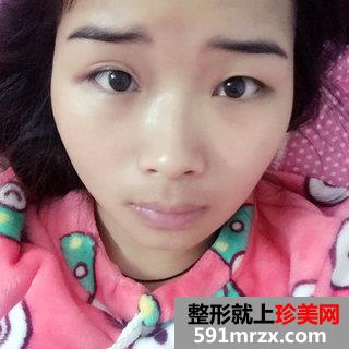 全切双眼皮+假体隆鼻+垫鼻尖最终效果图分享