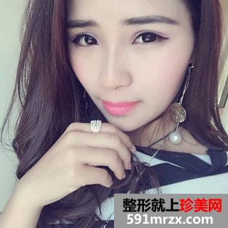 全切双眼皮+假体隆鼻+垫鼻尖最终效果图分享