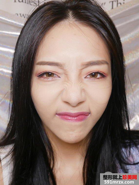 打完肉毒桿菌30天后
