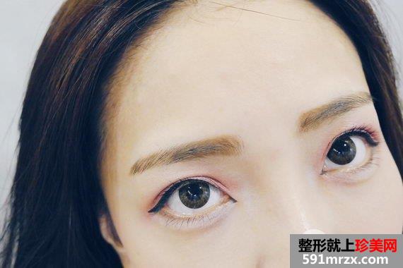 打完肉毒桿菌