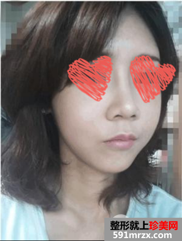 自体脂肪填充+隆鼻 变元气少女脸就是我！