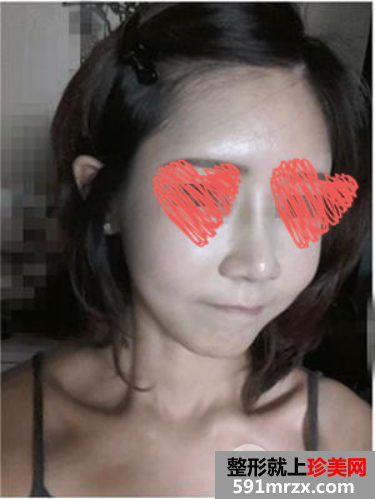 自体脂肪填充+隆鼻 变元气少女脸就是我！