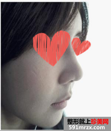 自体脂肪填充+隆鼻 变元气少女脸就是我！