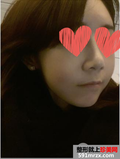 自体脂肪填充+隆鼻 变元气少女脸就是我！
