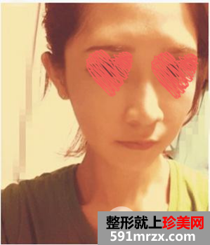 自体脂肪填充+隆鼻 变元气少女脸就是我！