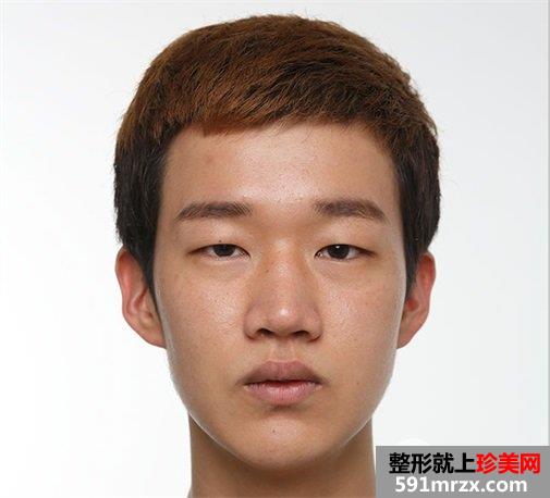 双眼皮 开眼角 定制隆鼻 隆下颏