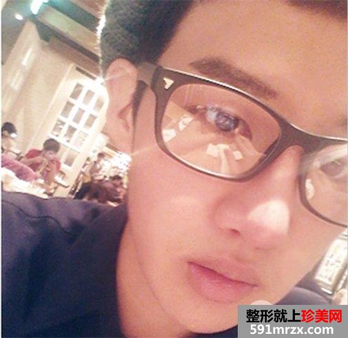 双眼皮 开眼角 定制隆鼻 隆下颏