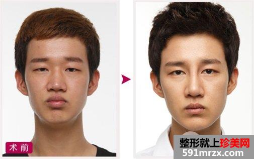 双眼皮 开眼角 定制隆鼻 隆下颏
