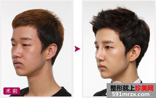 双眼皮 开眼角 定制隆鼻 隆下颏