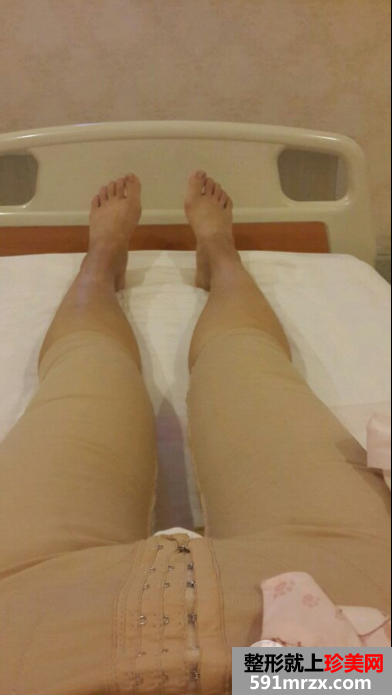 上个月做的大腿吸脂 亮几张我的恢复照片