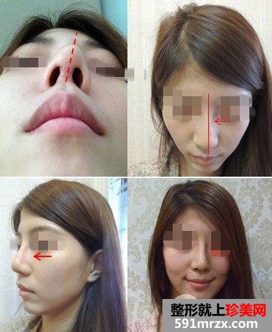 呱呱隆鼻失败鼻子变歪