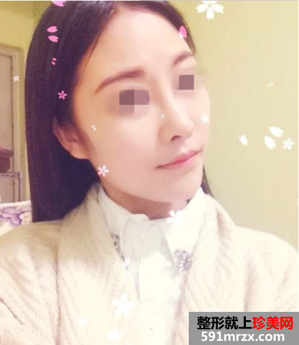 北京瑞丽舍医疗美容整形机构自体脂肪隆鼻案例和项目价格分享