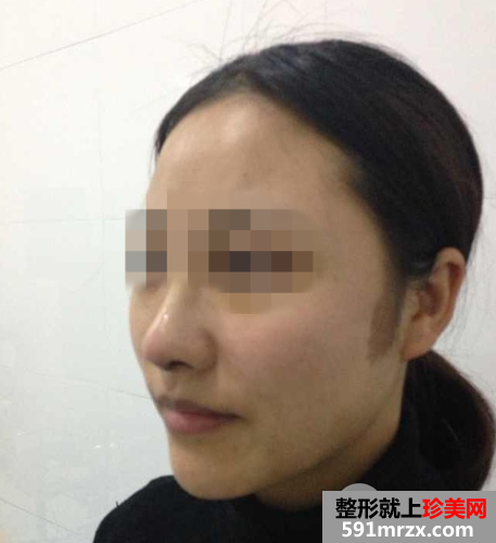 北京瑞丽舍医疗美容整形机构自体脂肪隆鼻案例和项目价格分享