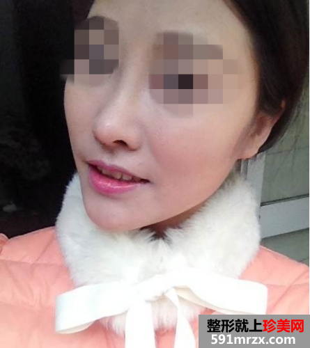 北京瑞丽舍医疗美容整形机构自体脂肪隆鼻案例和项目价格分享