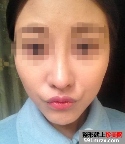 北京瑞丽舍医疗美容整形机构自体脂肪隆鼻案例和项目价格分享