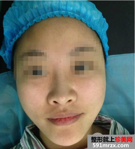 北京瑞丽舍医疗美容整形机构自体脂肪隆鼻案例和项目价格分享